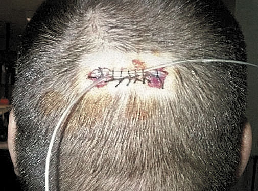 OPERATION: Thomas Yerrick had brain surgery in November 2010 to help alleviate his pain, but it failed.