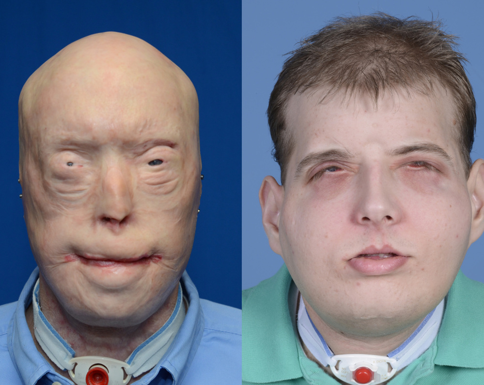 Patrick Hardison’s face was “one huge scar” before a transplant gave him a new look and optimism. He is still in physical therapy but hopes to return to his Mississippi home for Thanksgiving.