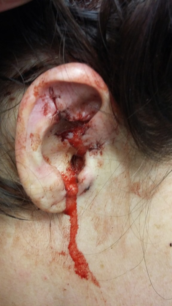 Cynthia Roodman, who sustained injuries during a dog attack in Gardiner, is calling on the city to enact tougher rules for dog owners.